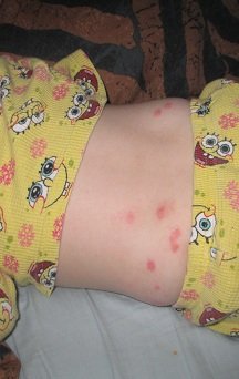 2013-03-14 - Chicken Pox