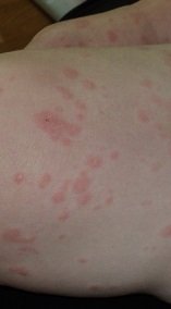 2013-06-24 - Katie's Rash