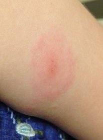 2014-05-31 - Lyme Disease