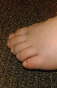 2016-04-25 - Katie's Toe