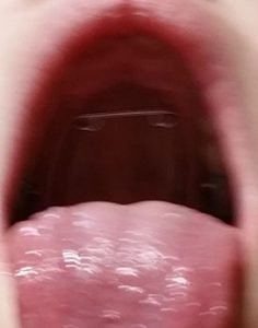 2017-04-25 - New Braces