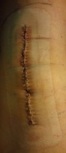 2018-05-01 - Knee Scar